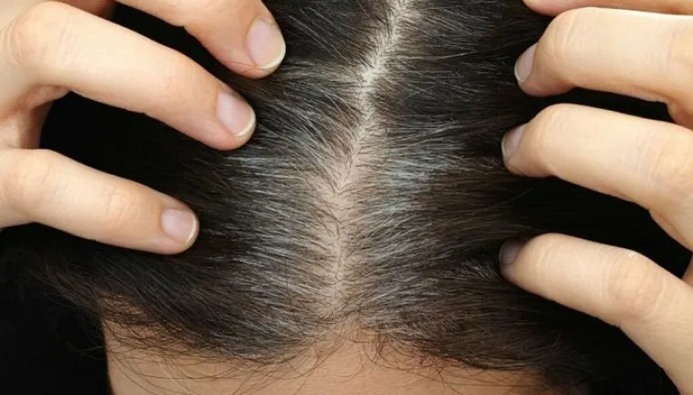 7 πιθανές αιτίες που έχουμε πρόωρο γκριζάρισμα μαλλιών