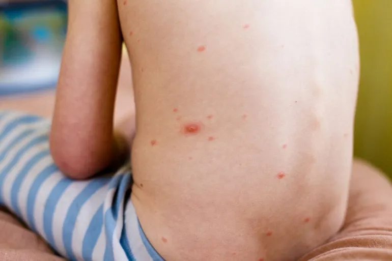 Μολυσματική τέρμινθος στο δέρμα: 7 συμπτώματα που πρέπει να γνωρίζουμε