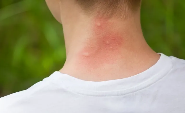 Κουνούπια: 7 φυσικές λύσεις για ν' ανακουφιστείτε από τη φαγούρα και τον πόνο